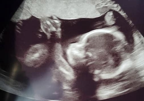 Planned Parenthood’s Tone Deaf Rally - Post-Abortive “Rage”